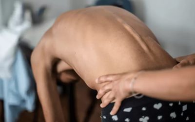 Schedule Your Scoliosis Assessment Today: Find Relief and Support at Winter Park Chiropractic