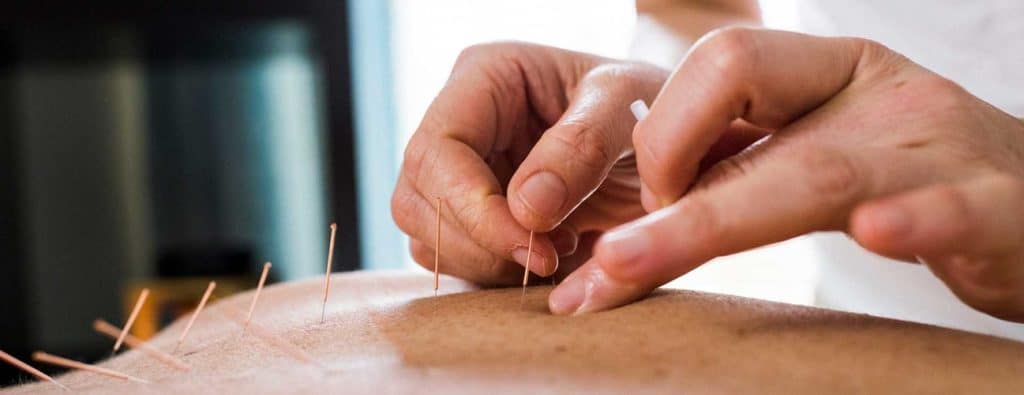 Acupuncture Near Me