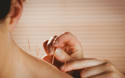 Acupuncture Near Me