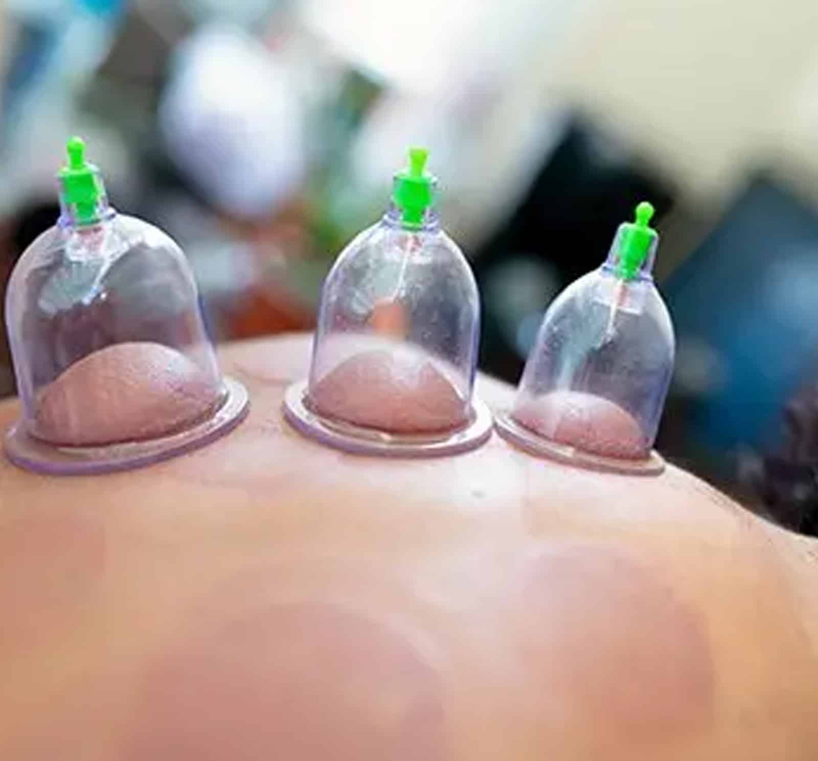 Chinese Cups Therapy